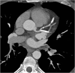 Calcified and Non- Calcified Plaque LAD and Circumflex - CTisus CT Scan