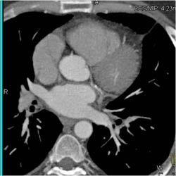 Stent in LAD - CTisus CT Scan