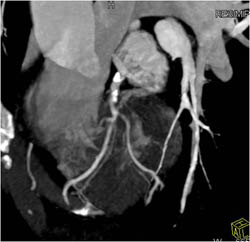 LAD Stenosis - CTisus CT Scan