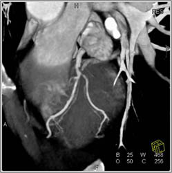 LAD Stenosis - CTisus CT Scan