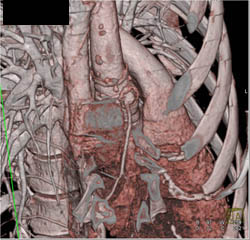 Dilated Reimplanted RCA - CTisus CT Scan