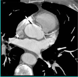 Plaque LAD - CTisus CT Scan