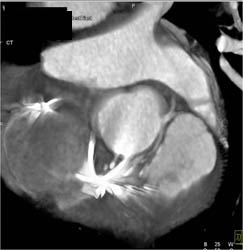 Artifact From Pacemaker Wires - CTisus CT Scan