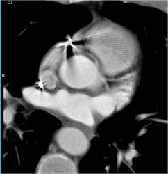 LAD Disease - CTisus CT Scan