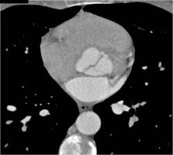 Bicuspid Valve in Coarctation of the Aorta (COA) Patient - CTisus CT Scan