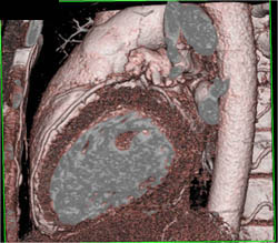 Normal LAD - CTisus CT Scan