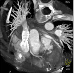 Dilated Aortic Root - CTisus CT Scan