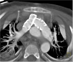 Togv - CTisus CT Scan