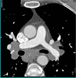 Incidental Sarcoidosis in Patient With Coronary Artery Disease - CTisus CT Scan