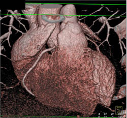 Normal RCA - CTisus CT Scan