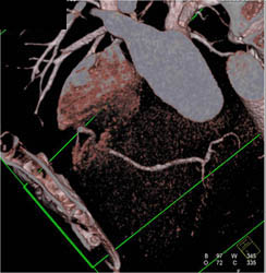 Plaque LAD - CTisus CT Scan