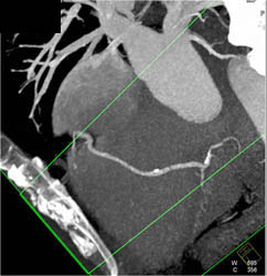 Plaque LAD - CTisus CT Scan