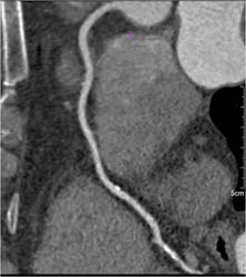 Plaque LAD - CTisus CT Scan