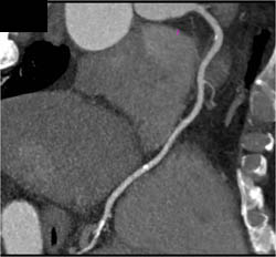 Plaque LAD - CTisus CT Scan