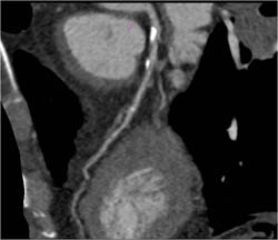 Plaque LAD - CTisus CT Scan