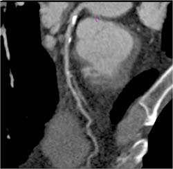 Plaque LAD - CTisus CT Scan