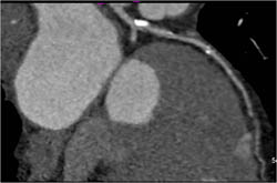 Plaque LAD - CTisus CT Scan