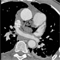 Air in Mediastinum S/P Surgery - CTisus CT Scan