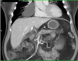 Pericardial Cyst - CTisus CT Scan