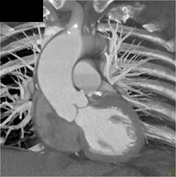 Dilated Ascending Aorta - CTisus CT Scan