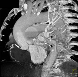 Dilated Ascending Aorta - CTisus CT Scan