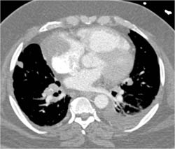 Cardiac Sarcoma - CTisus CT Scan