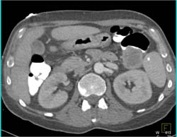 Lung Cancer Invades Atrium - CTisus CT Scan