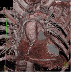 Patent Bypass Graft - CTisus CT Scan