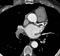 Significant Native LAD Disease With Bypass - CTisus CT Scan