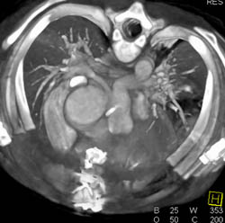 Right Pulmonary Artery Stenosis - CTisus CT Scan