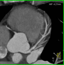 Plaque Without Critical Stenosis LAD - CTisus CT Scan