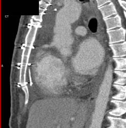 Foreign Body Behind Sternum - CTisus CT Scan