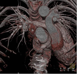 Dilated Origin of Right Main Coronary Artery - CTisus CT Scan