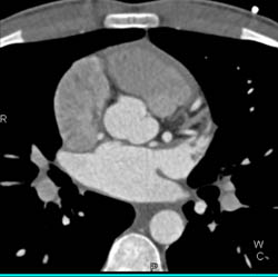 Coronary Artery Fistulae to Right Atrium- See Sequence of Images - CTisus CT Scan