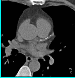 LAD Disease - CTisus CT Scan