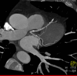 LAD Disease With Stenosis Less Than 50% - CTisus CT Scan