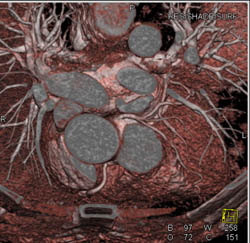 VRT Vs MIP of Normal Coronary CTA - CTisus CT Scan