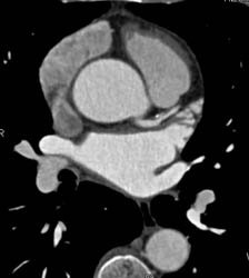 Calcified and Noncalcified Plaque With Less Than 50% LAD Stenosis - CTisus CT Scan