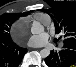 Normal RCA in A Few Perspectives - CTisus CT Scan