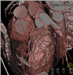 Normal Trifurcation of Left Main Coronary Artery - CTisus CT Scan