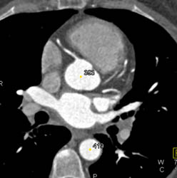 Good Enhancement of Cardiac Chambers With Saline Chaser - CTisus CT Scan