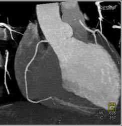 Normal RCA - CTisus CT Scan