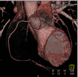 Normal RCA - CTisus CT Scan