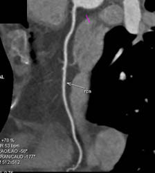 Normal RCA - CTisus CT Scan