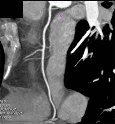 Normal RCA - CTisus CT Scan