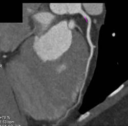 Normal RCA - CTisus CT Scan