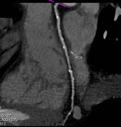 RCA With Calcified Plaque - CTisus CT Scan