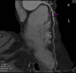 LAD With Calcified and Noncalcified Plaque - CTisus CT Scan