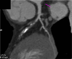 LAD Stenosis - CTisus CT Scan