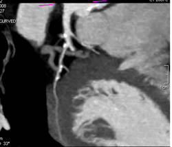 LAD Plaque - CTisus CT Scan